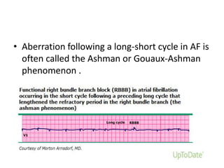 • Aberration following a long-short cycle in AF is
often called the Ashman or Gouaux-Ashman
phenomenon .

• Ecg of ashman phenomena

 