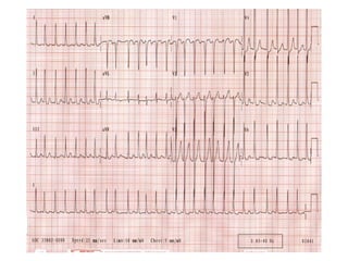 Atrial fibrillation | PPT