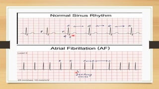 Atrial Fibrillations | PPTX