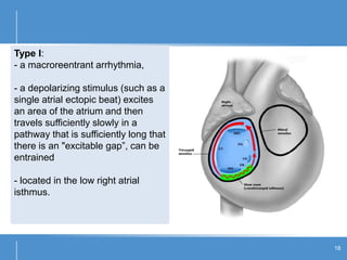 Type I:
- a macroreentrant arrhythmia,
- a depolarizing stimulus (such as a
single atrial ectopic beat) excites
an area of the atrium and then
travels sufficiently slowly in a
pathway that is sufficiently long that
there is an "excitable gap”, can be
entrained
- located in the low right atrial
isthmus.
18
 