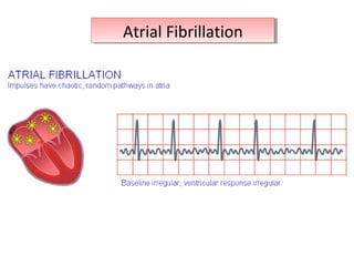 Atrial FibrillationAtrial Fibrillation
 