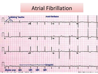 Atrial Fibrillation
 
