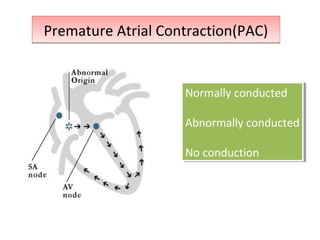 Premature Atrial Contraction(PAC)Premature Atrial Contraction(PAC)
Normally conducted
Abnormally conducted
No conduction
Normally conducted
Abnormally conducted
No conduction
 