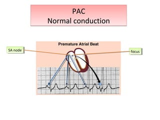 PAC
Normal conduction
PAC
Normal conduction
SA nodeSA node focusfocus
P
 