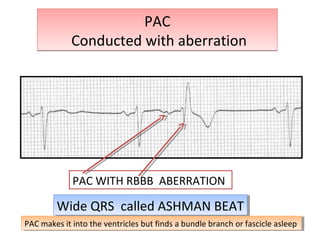 PAC
Conducted with aberration
PAC
Conducted with aberration
PAC WITH RBBB ABERRATION
Wide QRS called ASHMAN BEATWide QRS called ASHMAN BEAT
PAC makes it into the ventricles but finds a bundle branch or fascicle asleepPAC makes it into the ventricles but finds a bundle branch or fascicle asleep
 