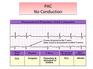 PAC
No Conduction
PAC
No Conduction
 