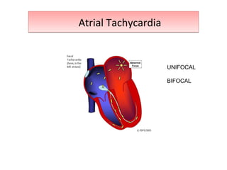 Atrial TachycardiaAtrial Tachycardia
UNIFOCAL
BIFOCAL
 