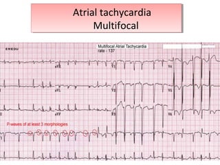 Atrial tachycardia
Multifocal
Atrial tachycardia
Multifocal
 