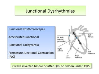 Junctional DysrhythmiasJunctional Dysrhythmias
Junctional Rhythm(escape)
Accelerated Junctional
Junctional Tachycardia
Premature Junctional Contraction
(PJC)
Junctional Rhythm(escape)
Accelerated Junctional
Junctional Tachycardia
Premature Junctional Contraction
(PJC)
P wave inverted before or after QRS or hidden under QRS.P wave inverted before or after QRS or hidden under QRS.
 