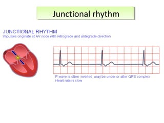 Junctional rhythmJunctional rhythm
 