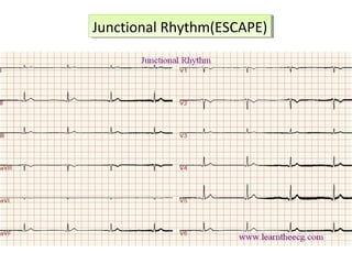 Junctional Rhythm(ESCAPE)Junctional Rhythm(ESCAPE)
 