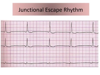 Junctional Escape Rhythm
 