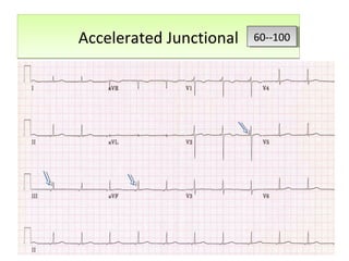 Accelerated JunctionalAccelerated Junctional 60--10060--100
 