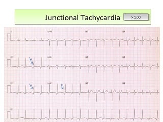 Junctional TachycardiaJunctional Tachycardia > 100> 100
 
