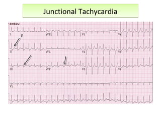 Junctional TachycardiaJunctional Tachycardia
p
 