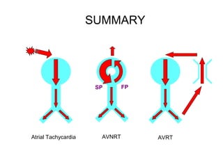 SUMMARY
Mechanisms of SVT
Atrial Tachycardia AVNRT AVRT
FPSP
 