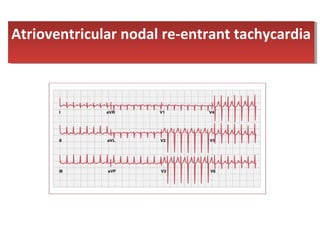 Atrioventricular nodal re-entrant tachycardiaAtrioventricular nodal re-entrant tachycardia
 