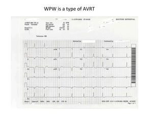 WPW is a type of AVRT
 