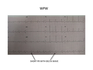 WPW
SHORT PR WITH DELTA WAVE
 