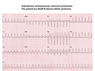 Orthodromic atrioventricular reentrant tachycardia.
This patient has Wolff-Parkinson-White syndrome.
 
