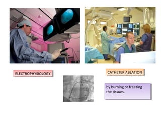 ELECTROPHYSIOLOGYELECTROPHYSIOLOGY CATHETER ABLATIONCATHETER ABLATION
by burning or freezing
the tissues.
by burning or freezing
the tissues.
 