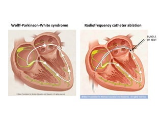 Wolff-Parkinson-White syndrome Radiofrequency catheter ablation
BUNDLE
OF KENT
 
