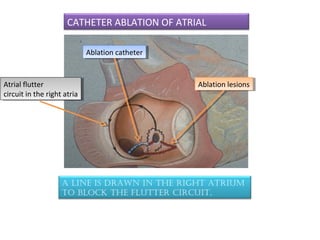 CATHETER ABLATION OF ATRIAL
FLUTTER
A line is drAwn in the right Atrium
to block the flutter circuit.
Atrial flutter
circuit in the right atria
Atrial flutter
circuit in the right atria
Ablation lesionsAblation lesions
Ablation catheterAblation catheter
 