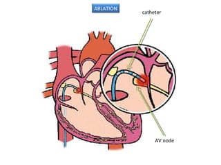 catheter
AV node
ABLATION
 