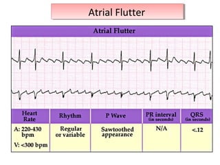 Atrial FlutterAtrial Flutter
 