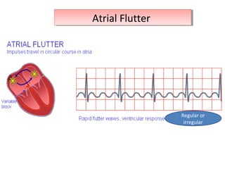 Atrial FlutterAtrial Flutter
Regular or
irregular
 