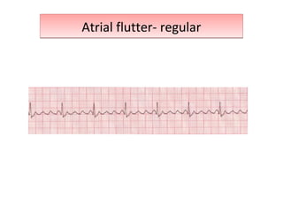 Atrial flutter- regularAtrial flutter- regular
 