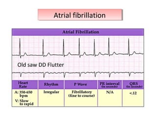 Old saw DD Flutter
Atrial fibrillationAtrial fibrillation
 