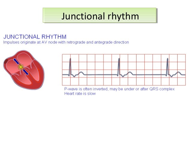 activity for junctional escape rhythm
