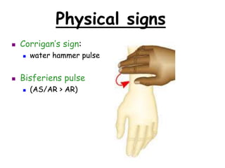 Physical signs
 Corrigan’s sign:
 water hammer pulse
 Bisferiens pulse
 (AS/AR > AR)
 