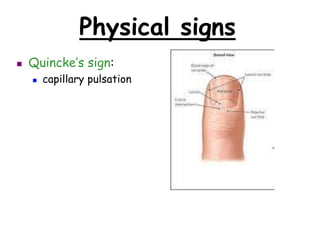 Physical signs
 Quincke’s sign:
 capillary pulsation
 
