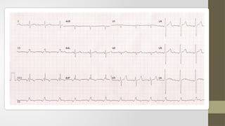 All you want to know about atrial rhythm.pptx