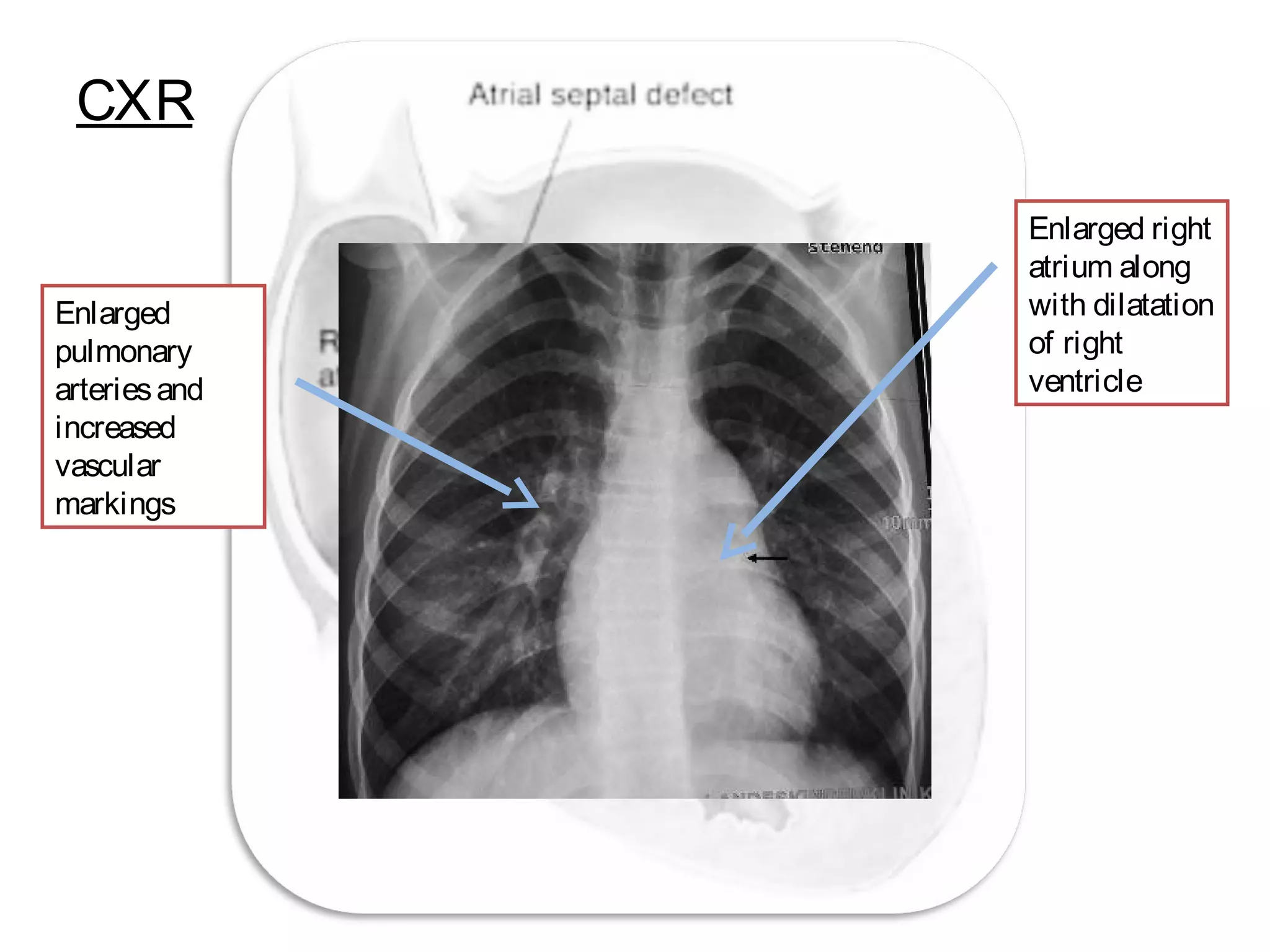 CXR
Enlarged
pulmonary
arteriesand
increased
vascular
markings
Enlarged right
atrium along
with dilatation
of right
ventricle
 