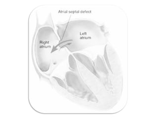 Atrial septal defect | PPT