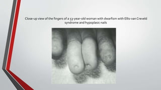 Close-up view of the fingers of a 53-year-old woman with dwarfism with Ellis-van Creveld 
syndrome and hypoplasic nails 
 