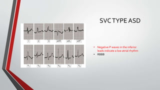 SVC TYPE ASD 
• Negative P waves in the inferior 
leads indicate a low atrial rhythm 
• RBBB 
 