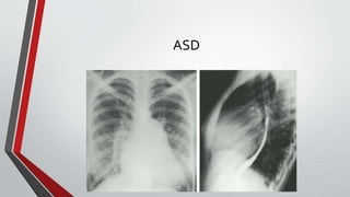 ASD 
 