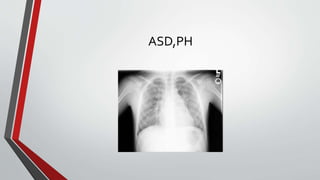 ASD,PH 
 