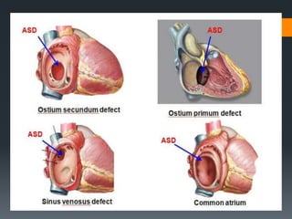 Atrial septal defect | PPTX