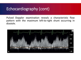 Atrial septal defect | PPTX
