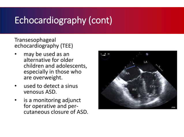 Atrial septal defect | PPTX