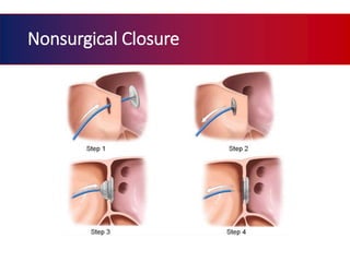 Atrial septal defect | PPTX