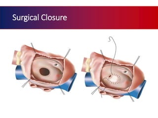 Patch Closure Atrial septal defect | PPTX