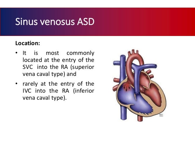Atrial septal defect
Sinus Venosus Asd