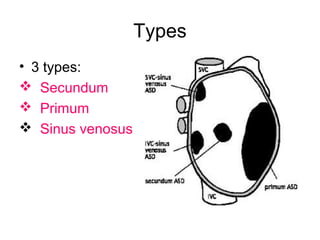 Atrial septal defect | PPT