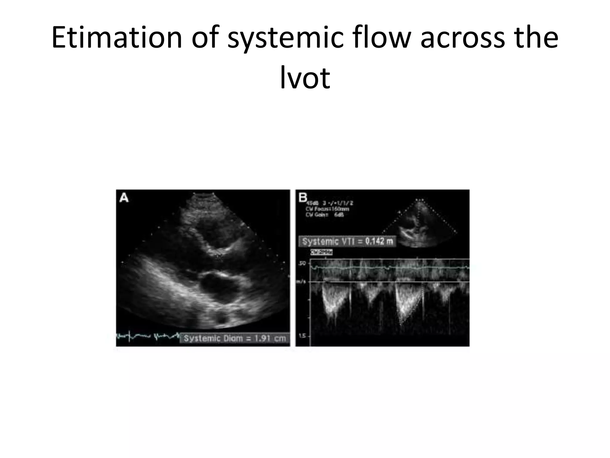 Etimation of systemic flow across the
lvot
 